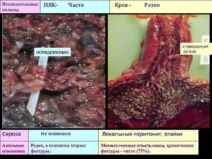 Воспалительные полипы НЯК- Часто псевдополип Сероза Анальные изменения Не изменена Редко, в основном острые