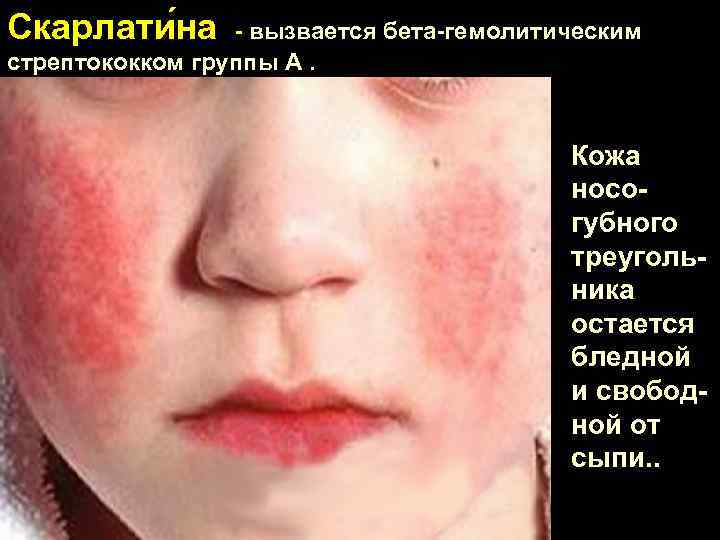 Скарлати на - вызвается бета-гемолитическим стрептококком группы А. Кожа носогубного треугольника остается бледной и