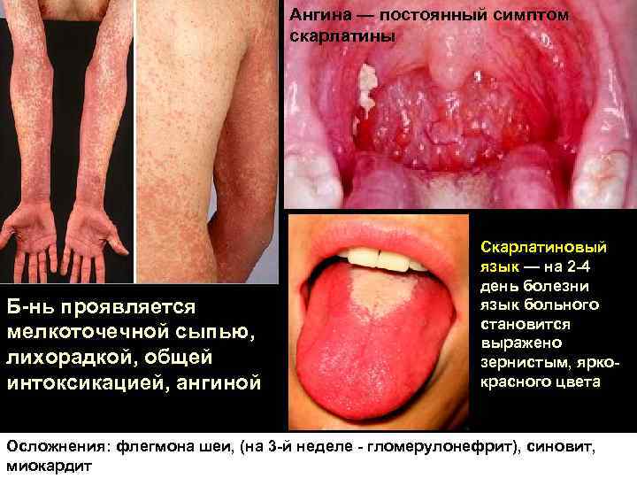 Ангина — постоянный симптом скарлатины Б-нь проявляется мелкоточечной сыпью, лихорадкой, общей интоксикацией, ангиной Скарлатиновый