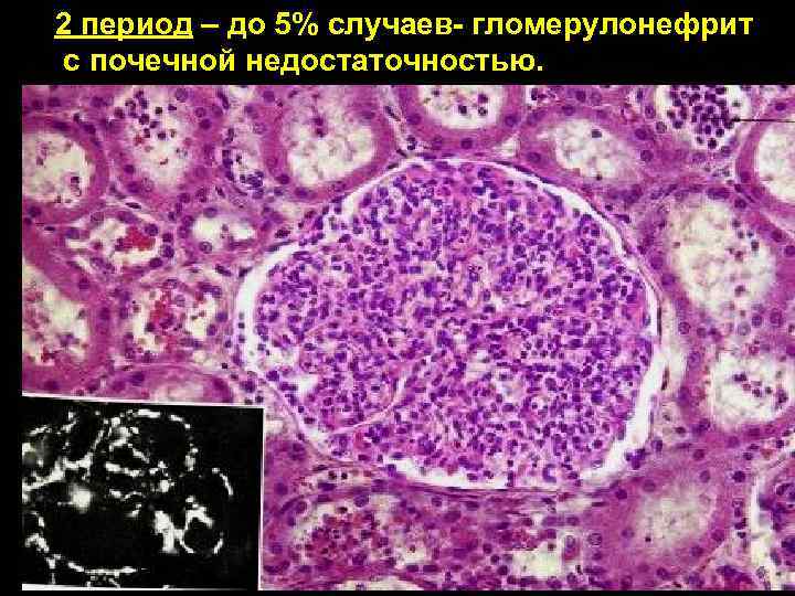 2 период – до 5% случаев- гломерулонефрит с почечной недостаточностью. 