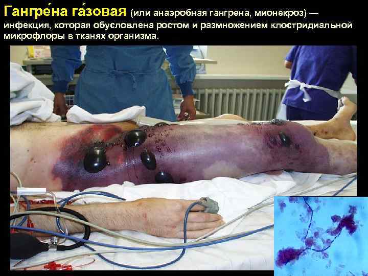 Гангре на га зовая (или анаэробная гангрена, мионекроз) — инфекция, которая обусловлена ростом и