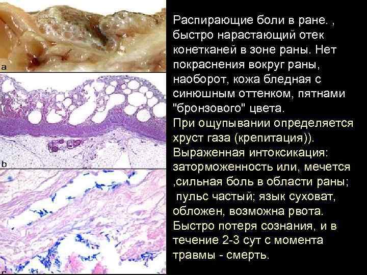 Распирающие боли в ране. , быстро нарастающий отек конетканей в зоне раны. Нет покраснения