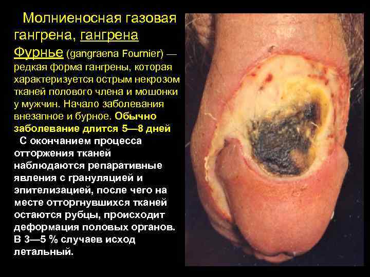 Молниеносная газовая гангрена, гангрена Фурнье (gangraena Fournier) — редкая форма гангрены, которая характеризуется острым
