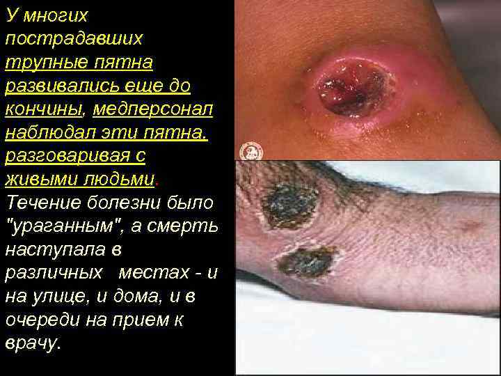 У многих пострадавших трупные пятна развивались еще до кончины, медперсонал наблюдал эти пятна, разговаривая