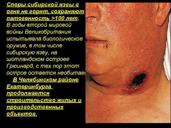 Споры сибирской язвы в огне не горят, сохраняют патогенность >100 лет. В годы второй