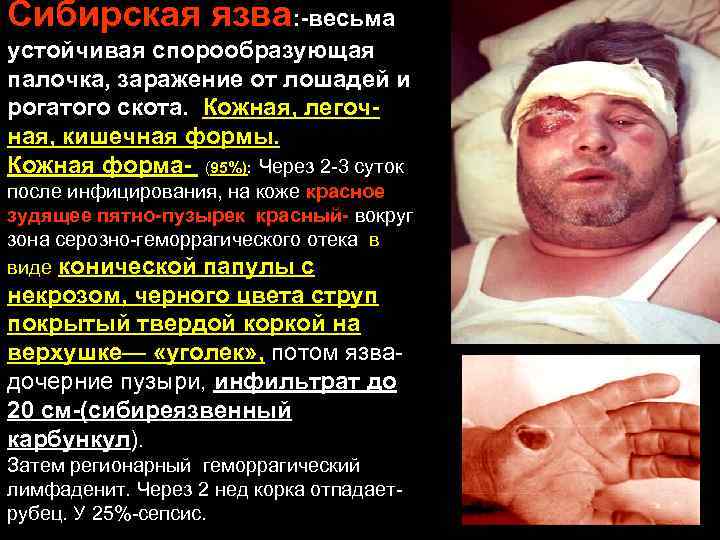 Сибирская язва: -весьма устойчивая спорообразующая палочка, заражение от лошадей и рогатого скота. Кожная, легочная,