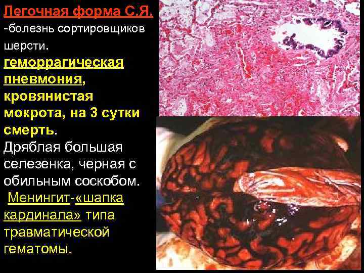 Легочная форма С. Я. -болезнь сортировщиков шерсти. геморрагическая пневмония, кровянистая мокрота, на 3 сутки