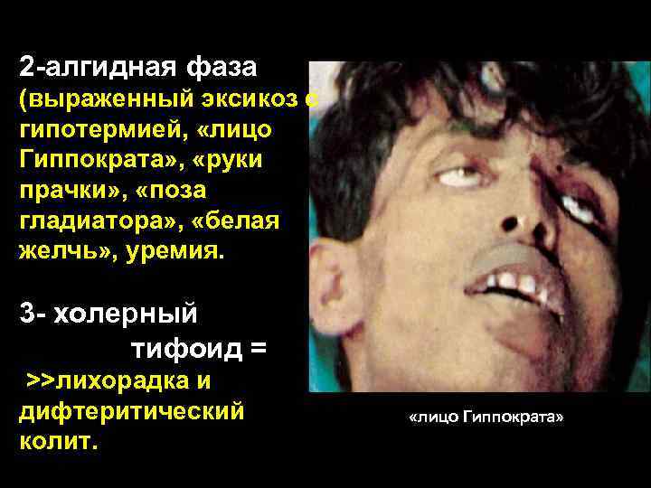 2 -алгидная фаза (выраженный эксикоз с гипотермией, «лицо Гиппократа» , «руки прачки» , «поза