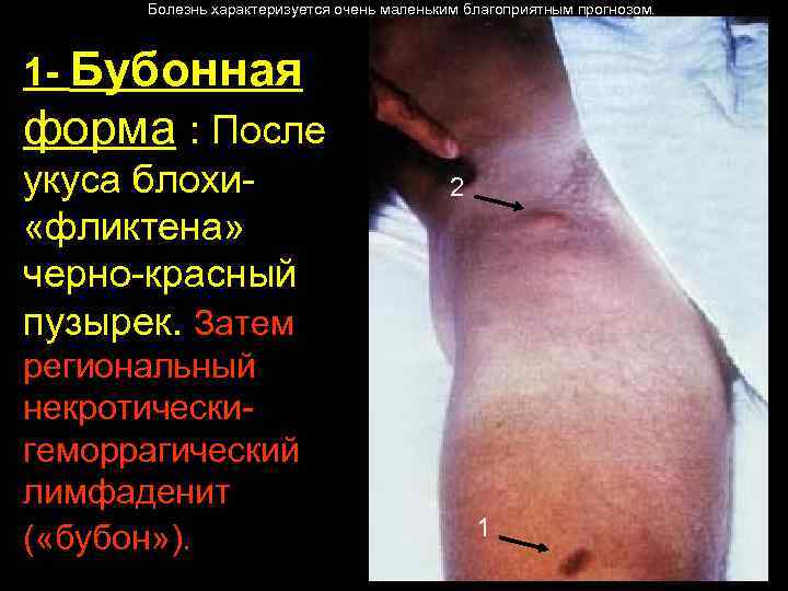 Болезнь характеризуется очень маленьким благоприятным прогнозом. 1 - Бубонная форма : После укуса блохи