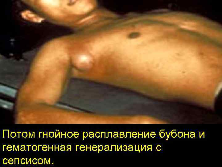 Потом гнойное расплавление бубона и гематогенная генерализация с сепсисом. 