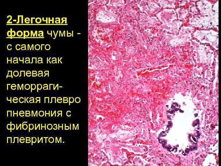 2 -Легочная форма чумы с самого начала как долевая геморрагическая плевро пневмония с фибринозным
