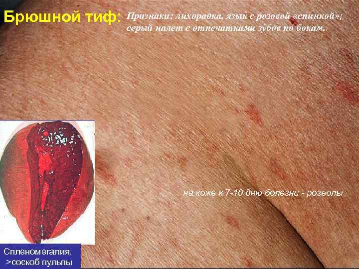 Брюшной тиф: Признаки: лихорадка, язык с розовой «спинкой» ; серый налет с отпечатками зубов