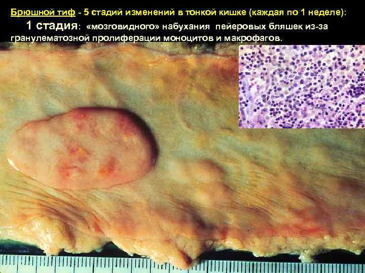 Брюшной тиф - 5 стадий изменений в тонкой кишке (каждая по 1 неделе): 1