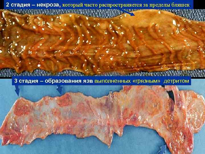 2 стадия – некроза, который часто распространяется за пределы бляшек. 3 стадия – образования