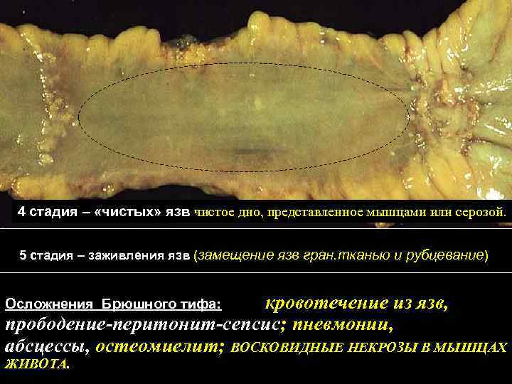 4 стадия – «чистых» язв чистое дно, представленное мышцами или серозой. 5 стадия –