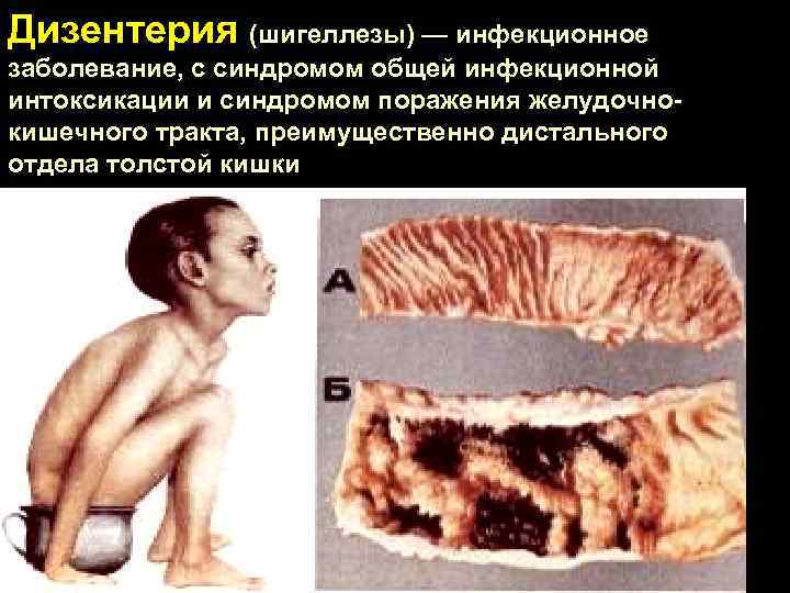 Дизентерия (шигеллезы) — инфекционное заболевание, с синдромом общей инфекционной интоксикации и синдромом поражения желудочнокишечного