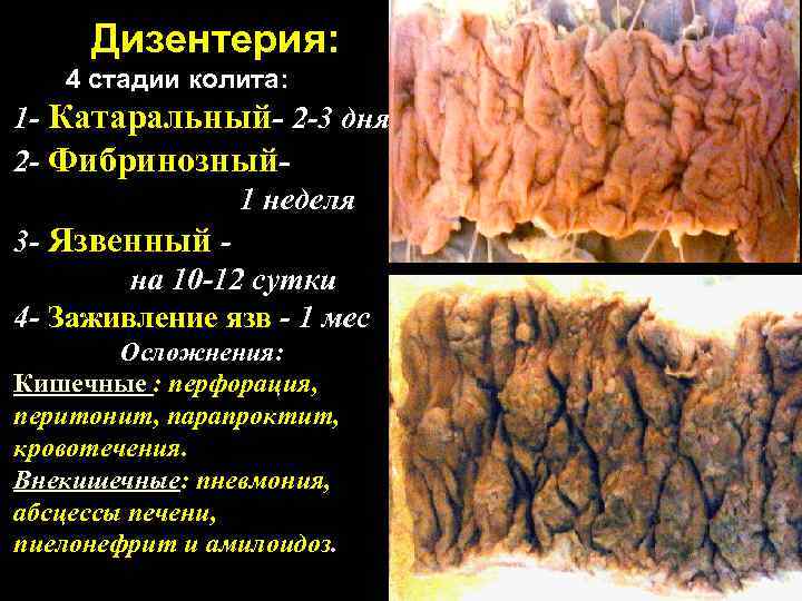  Дизентерия: 4 стадии колита: 1 - Катаральный- 2 -3 дня 2 - Фибринозный