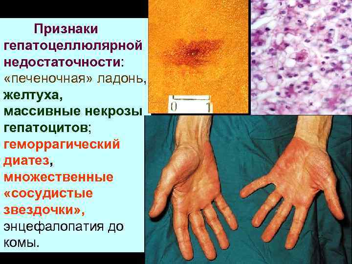 Признаки гепатоцеллюлярной недостаточности: «печеночная» ладонь, желтуха, массивные некрозы гепатоцитов; геморрагический диатез, множественные «сосудистые звездочки»
