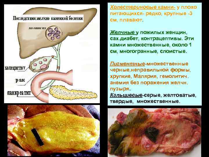 Холестериновые камни- у плохо питающихся- редко, крупные -3 см, плавают. Желчные у пожилых женщин,