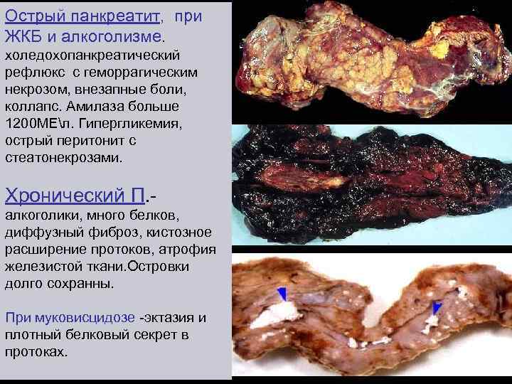 Острый панкреатит, при ЖКБ и алкоголизме. холедохопанкреатический рефлюкс с геморрагическим некрозом, внезапные боли, коллапс.