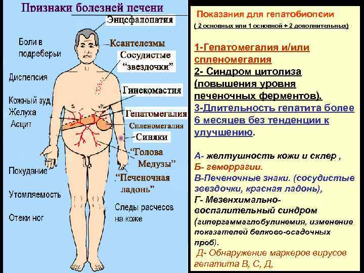 Показания для гепатобиопсии ( 2 основных или 1 основной + 2 дополнительных) 1 -Гепатомегалия