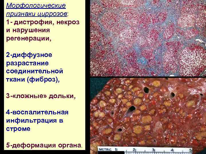 Морфологические признаки циррозов: 1 - дистрофия, некроз и нарушения регенерации, 2 -диффузное разрастание соединительной