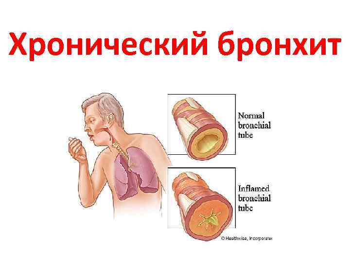 Хронический бронхит 