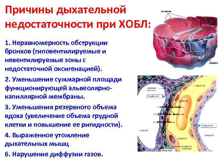 Причины дыхательной недостаточности при ХОБЛ: 1. Неравномерность обструкции бронхов (гиповентилируемые и невентилируемые зоны с