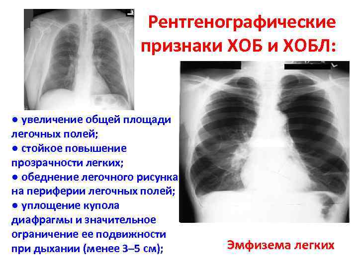 Обеднение сосудистого рисунка легких характерно для