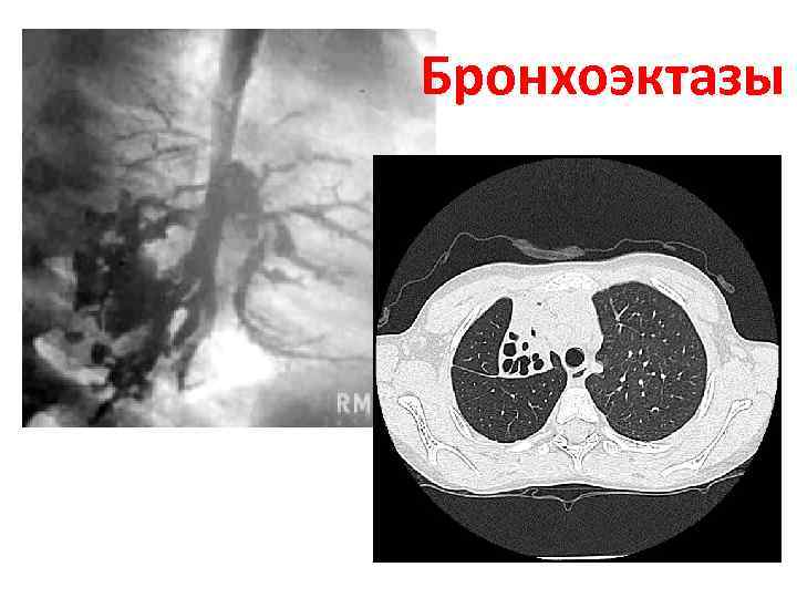 Кт картина бронхоэктазов