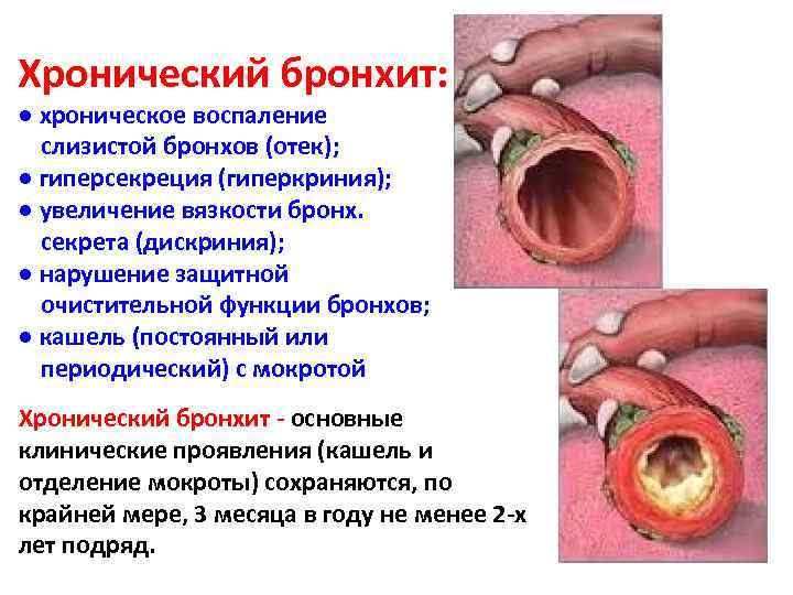 Хронический бронхит карта вызова смп