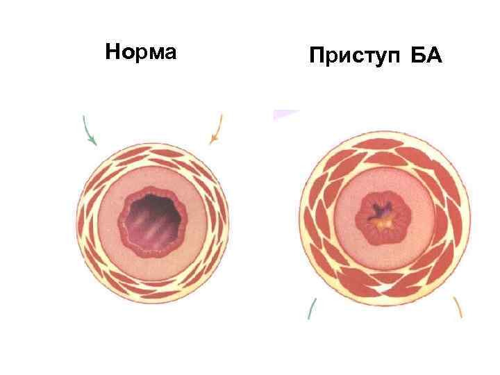 Норма Приступ БА 