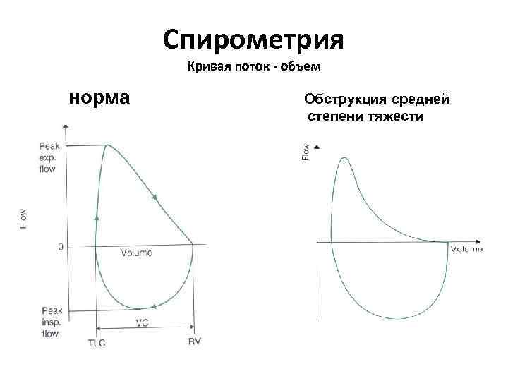 Спирометрия Кривая поток - объем норма Обструкция средней степени тяжести 
