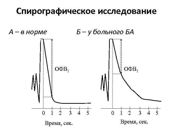 Спирографическое исследование А – в норме Б – у больного БА ОФВ 1 0