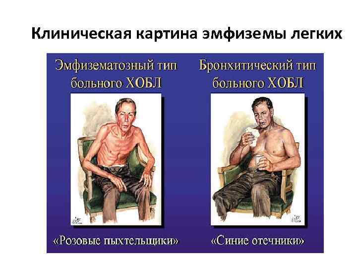 Клиническая картина эмфиземы легких 