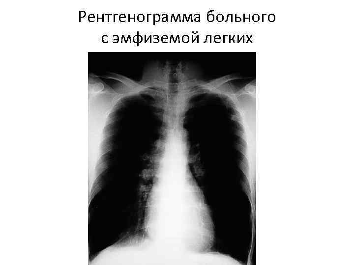 Рентгенограмма больного с эмфиземой легких 