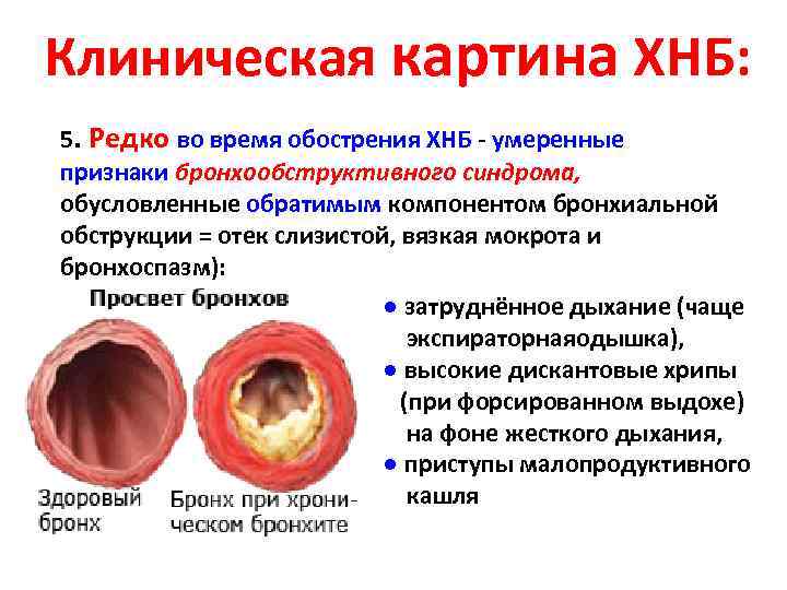 Клиническая картина ХНБ: 5. Редко во время обострения ХНБ - умеренные признаки бронхообструктивного синдрома,