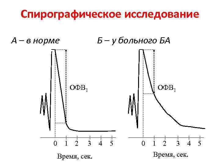 Спирографическое исследование А – в норме Б – у больного БА ОФВ 1 0