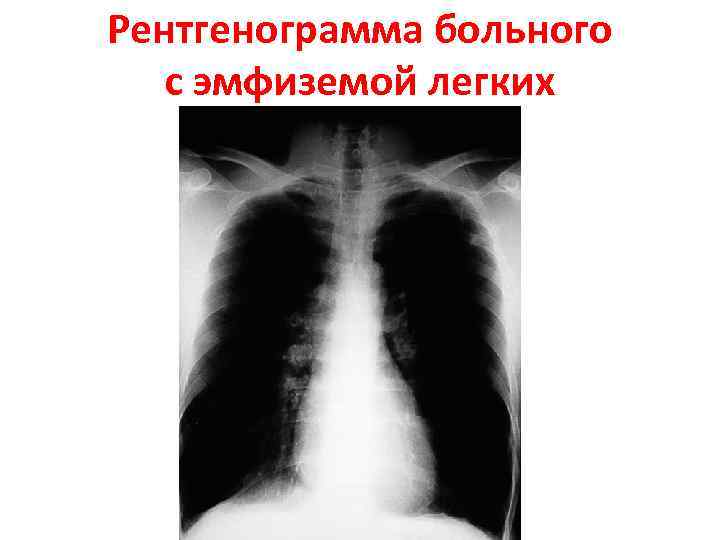 Рентгенограмма больного с эмфиземой легких 