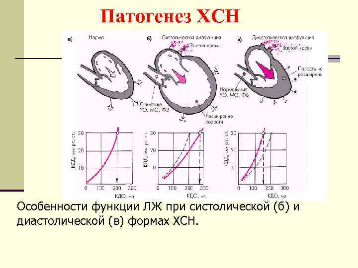 Патогенез ХСН Особенности функции ЛЖ при систолической (б) и диастолической (в) формах ХСН. 