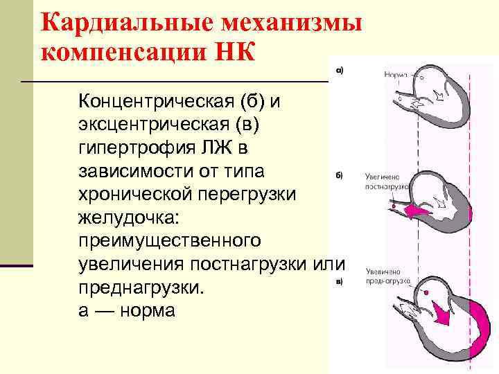 Кардиальные механизмы компенсации НК Концентрическая (б) и эксцентрическая (в) гипертрофия ЛЖ в зависимости от