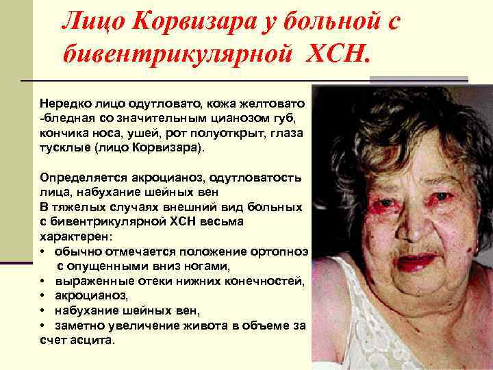 Лицо Корвизара у больной с бивентрикулярной ХСН. Нередко лицо одутловато, кожа желтовато -бледная со