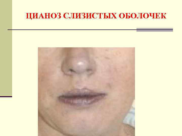 ЦИАНОЗ СЛИЗИСТЫХ ОБОЛОЧЕК 