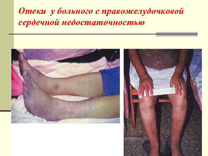 Отеки у больного с правожелудочковой сердечной недостаточностью 