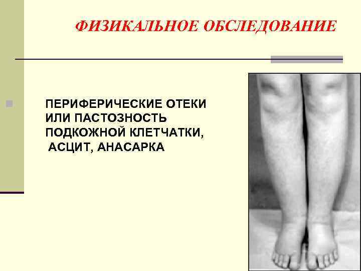 ФИЗИКАЛЬНОЕ ОБСЛЕДОВАНИЕ n ПЕРИФЕРИЧЕСКИЕ ОТЕКИ ИЛИ ПАСТОЗНОСТЬ ПОДКОЖНОЙ КЛЕТЧАТКИ, АСЦИТ, АНАСАРКА 