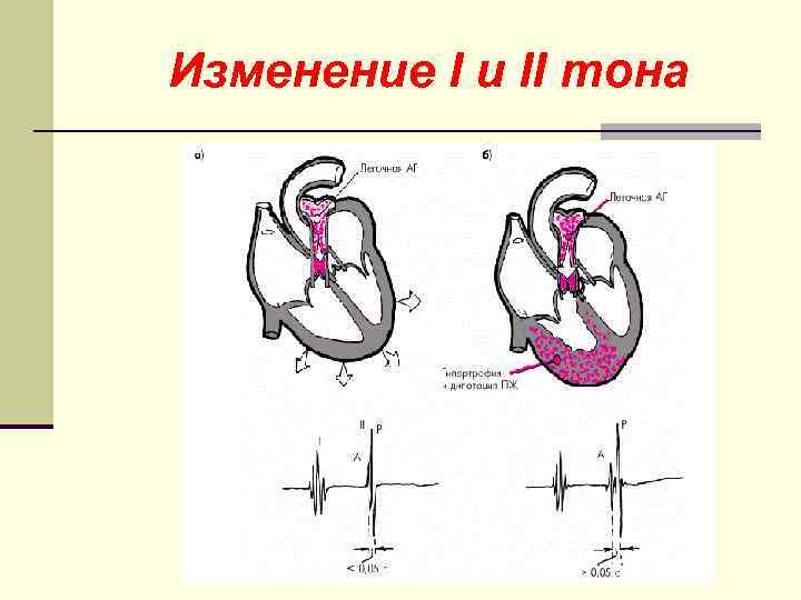 Изменение I и II тона 