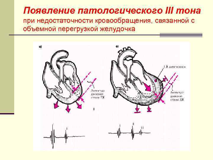 Появление патологического III тона при недостаточности кровообращения, связанной с объемной перегрузкой желудочка 