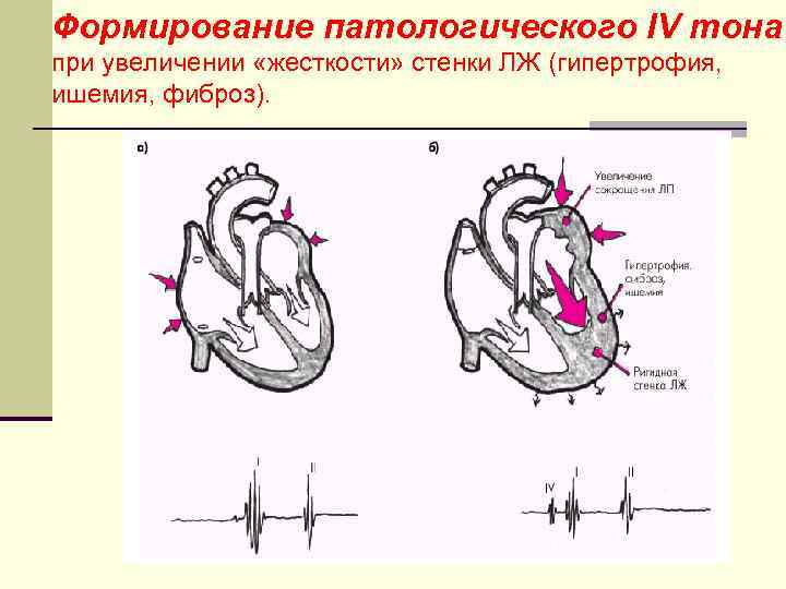 Формирование патологического IV тона при увеличении «жесткости» стенки ЛЖ (гипертрофия, ишемия, фиброз). 