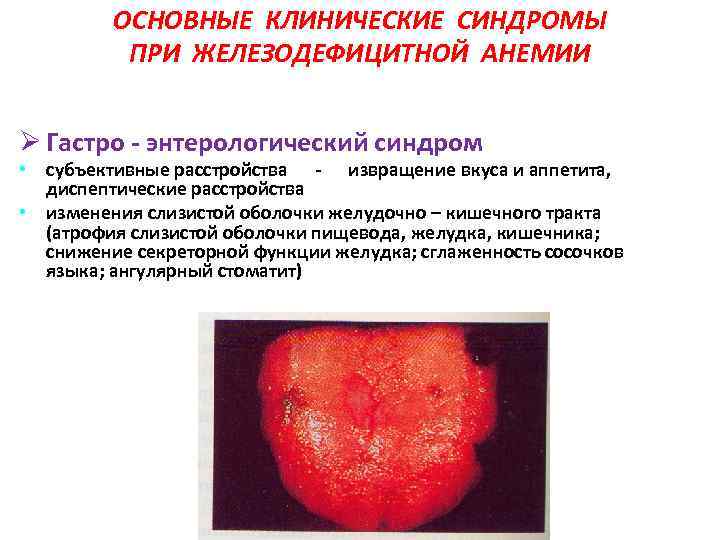 ОСНОВНЫЕ КЛИНИЧЕСКИЕ СИНДРОМЫ ПРИ ЖЕЛЕЗОДЕФИЦИТНОЙ АНЕМИИ Ø Гастро - энтерологический синдром • субъективные расстройства