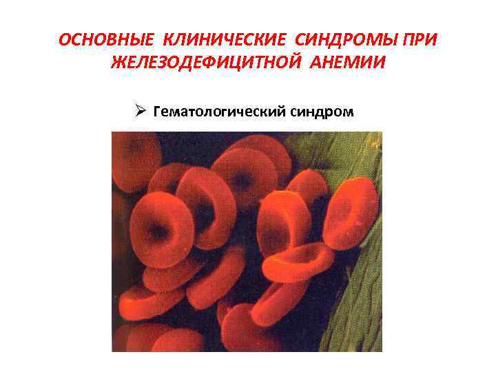 ОСНОВНЫЕ КЛИНИЧЕСКИЕ СИНДРОМЫ ПРИ ЖЕЛЕЗОДЕФИЦИТНОЙ АНЕМИИ Ø Гематологический синдром 